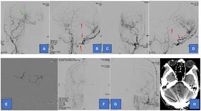 Endovascular treatment strategy and clinical outcome of tentorial dural arteriovenous fistula